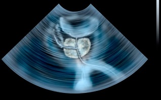 diagnosis of prostatitis