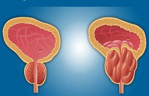 prostatitis photo