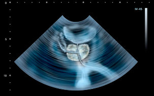 Symptoms of prostatitis on the ULTRASOUND