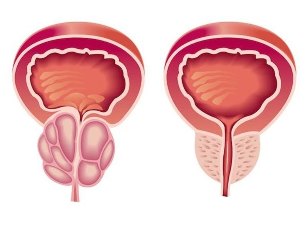 How it looks like prostatitis